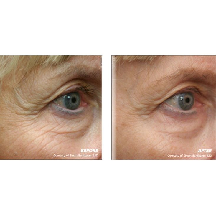 pelleve skin tightening near me